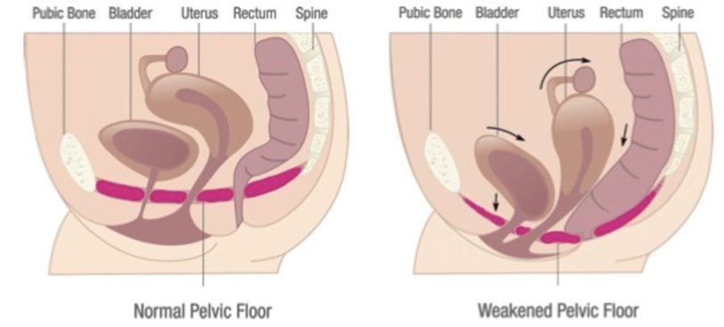 Vaginal Tightening Laser