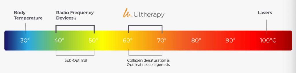 Ultherapy temperature