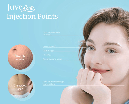 juvelook skin booster injection point