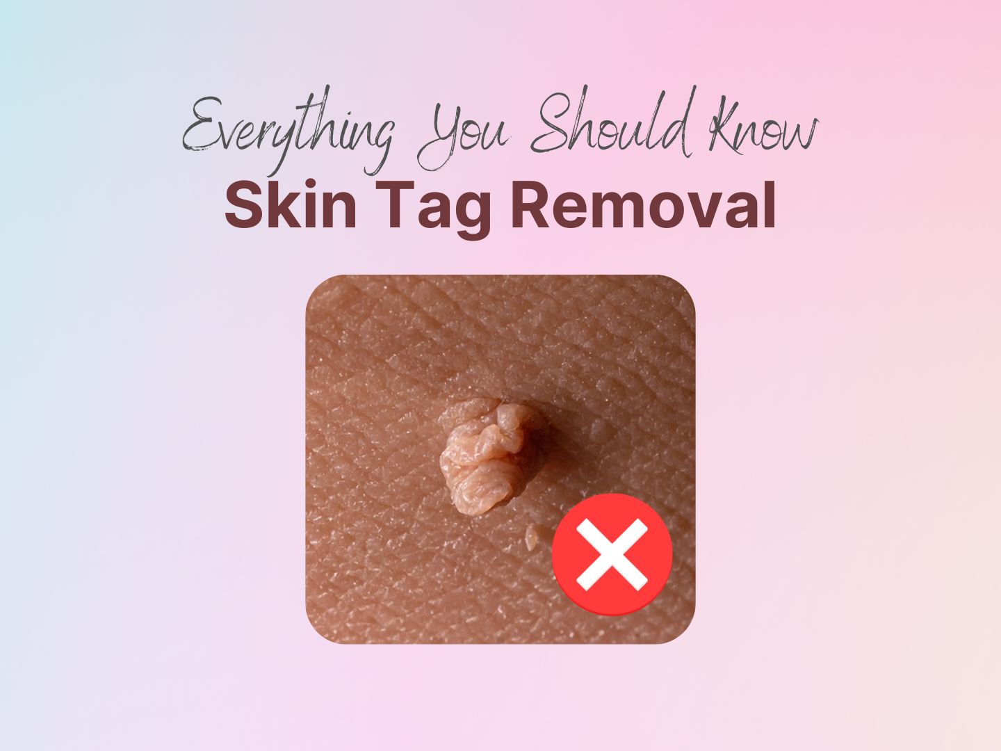 Skin tag removal malaysia
