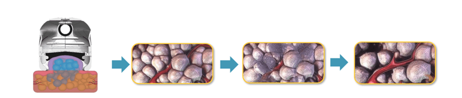 cooltech fat freezing