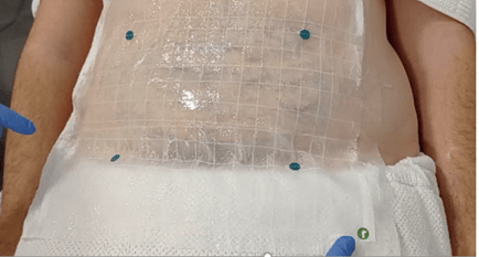 cooltech fat freezing