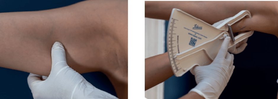 cooltech fat freezing