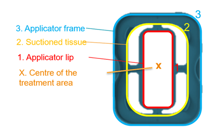 cooltech fat freezing