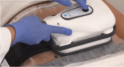 cooltech fat freezing